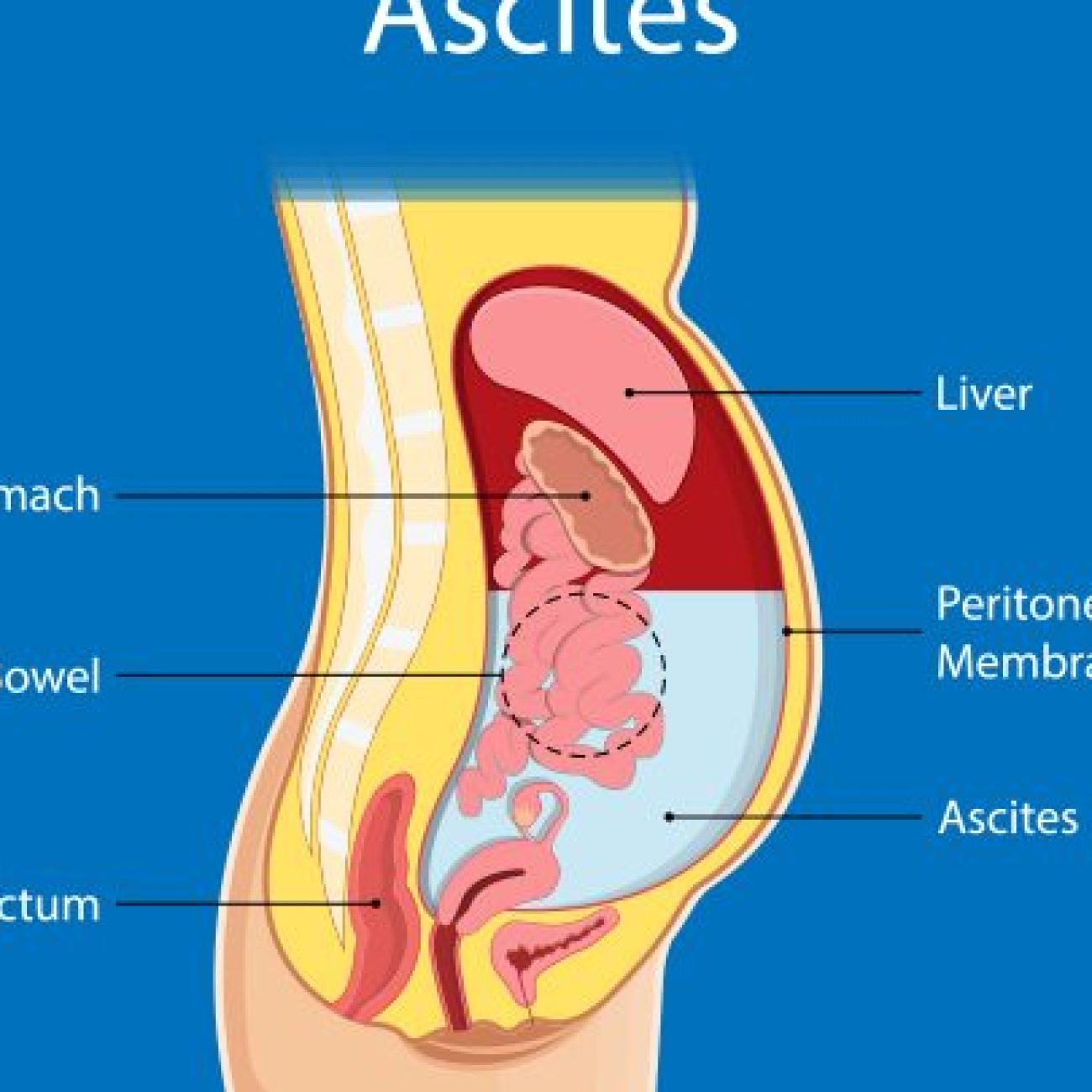 Ayurvedic Toxins Flush Out Water